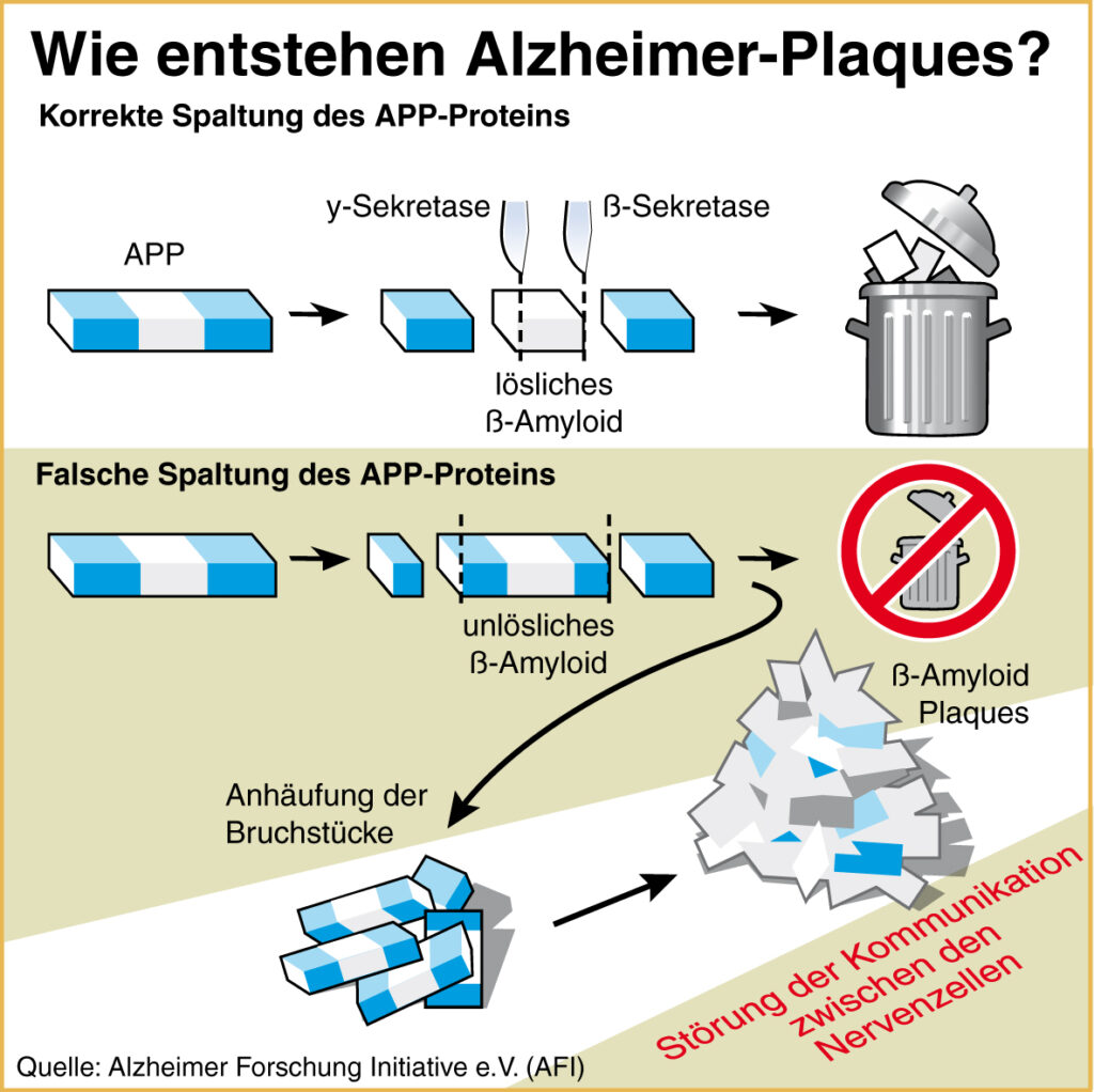 Alzheimer Itzehoe Plaqueablagerungen